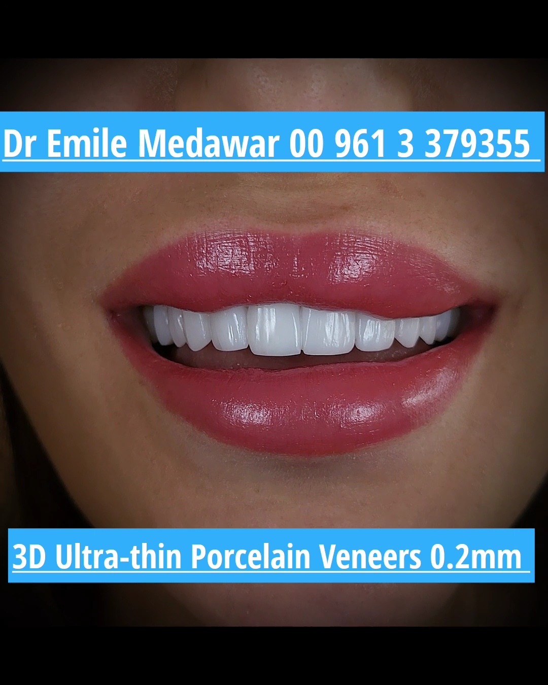 Very thin and transparent dental veneers in Lebanon