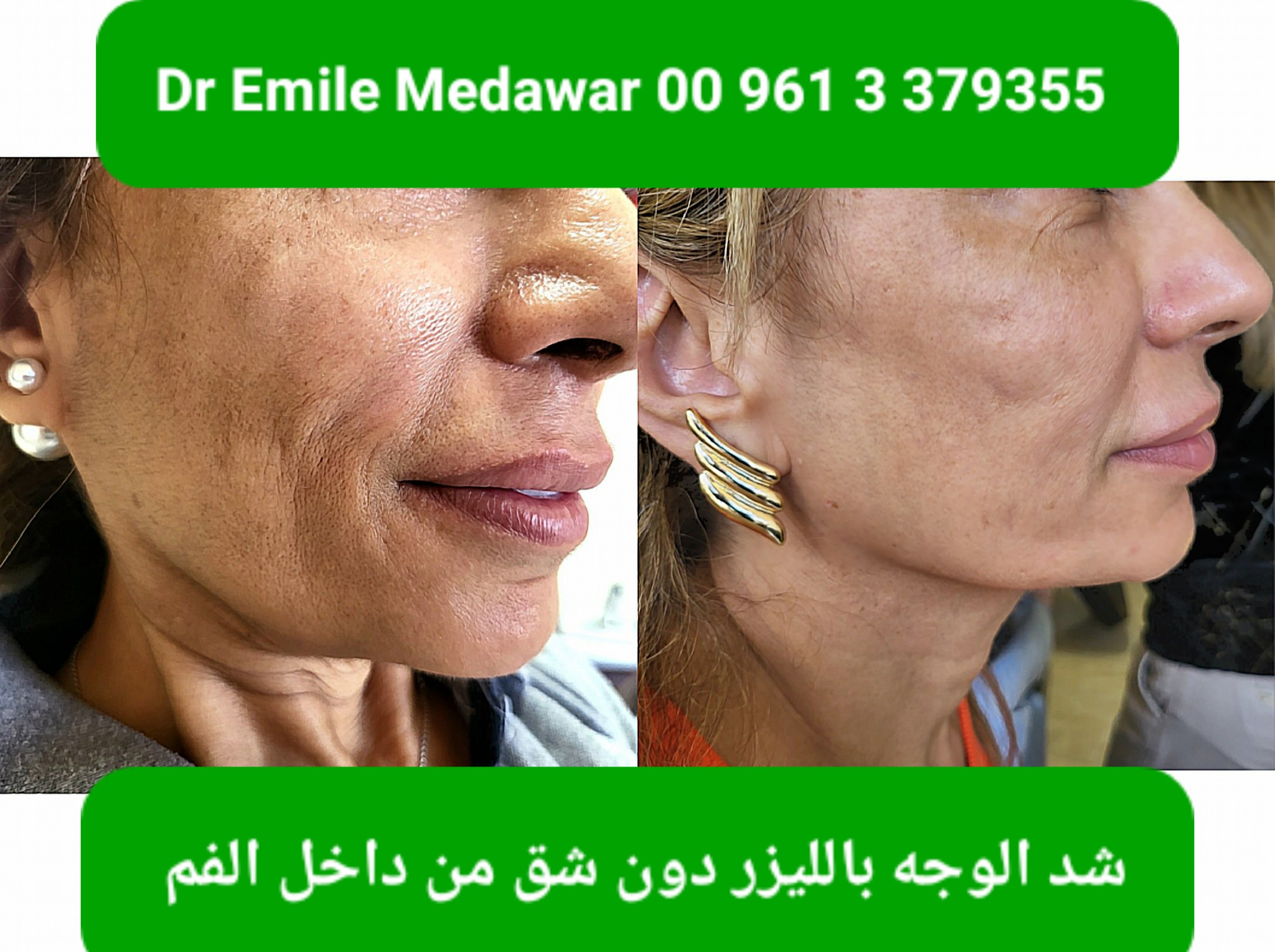 Intraoral laser facelift lebanon