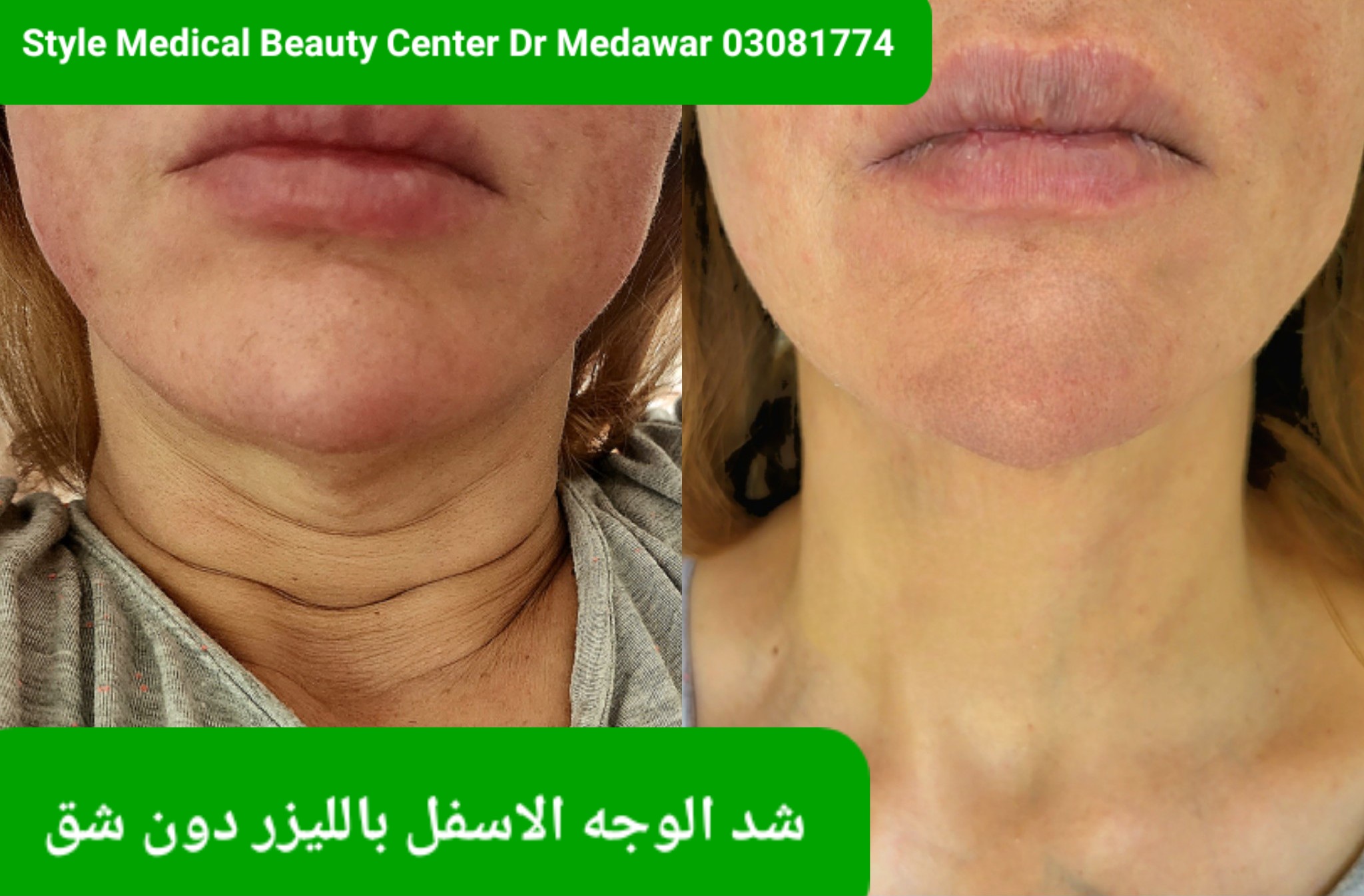 Non-surgical laser facial rejuvenation beirut Lebanon