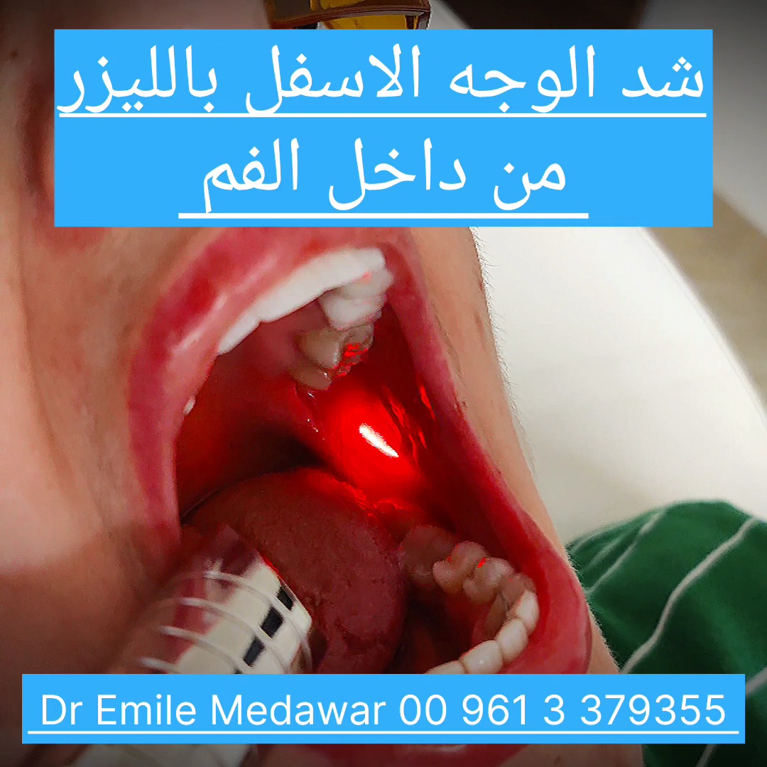 laser face lift without surgery lebanon